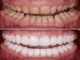Full Mouth Rehabilitation Before After