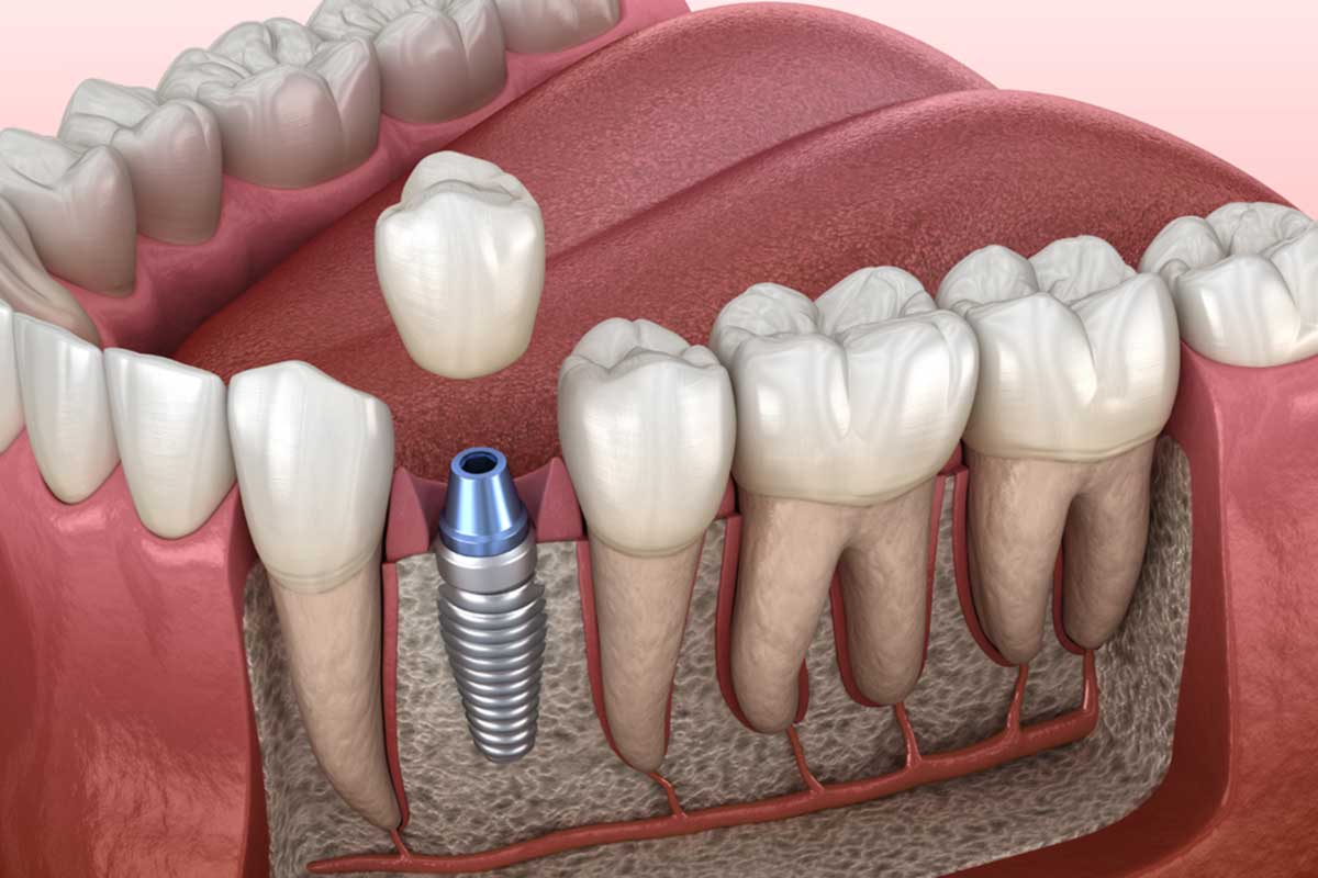 Single Implant Before After