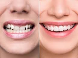 Smile Designing Before After